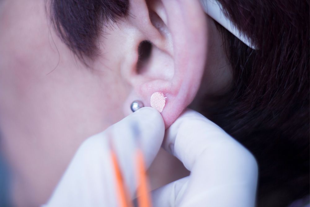 Ο ωτοβελονισμός, είναι ένα σύστημα βελονισμού που έχει σχεδιαστεί για τη θεραπεία ολόκληρου του σώματος από το αυτί. 