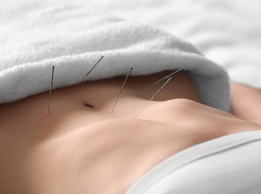 Σύνδρομο Πολυκυστικών Ωοθηκών: Η βελονιστική θεραπεία, έχει αναδειχθεί ως μια συμπληρωματική προσέγγιση για τον έλεγχο των συμπτωμάτων